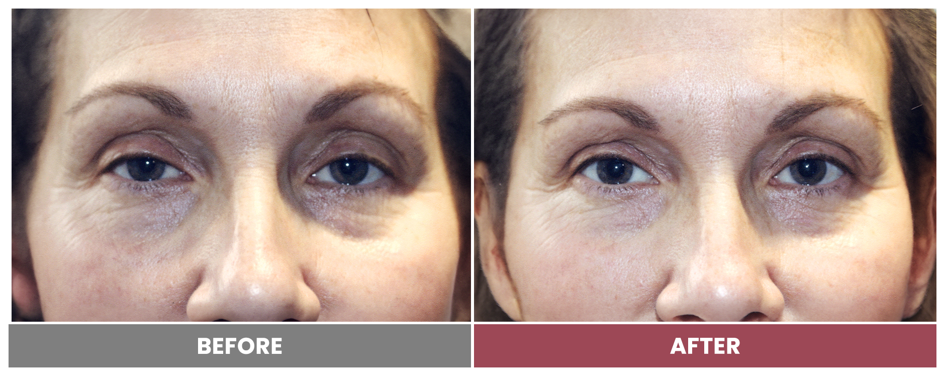 PTOSIS REPAIR - Case 45